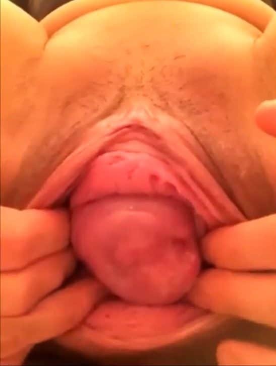 Her pussy falls out – crazy prolapsed vagina